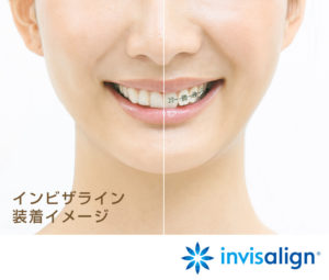 invisalign_img_sp (1)