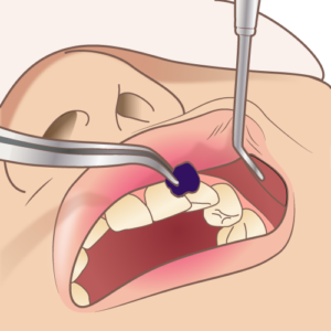 dental_disclosing_solution_1